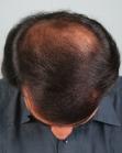 Before Hair Transplant&nbsp;Midscalp